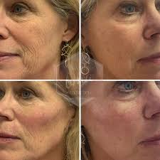 Unveiling Radiant Skin: Botox Treatments in Yardley, PA post thumbnail image
